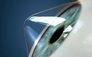 Кератоконус глаза: причины, симптомы и лечение