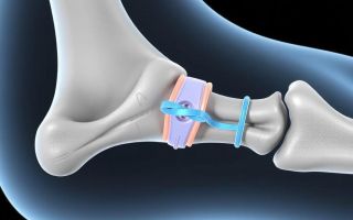 Остеосинтез: надежная фиксация для правильного сращения кости