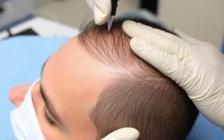 Новые волосы вместо шрама: как работает пересадка волос на шрам, рубец и ожог