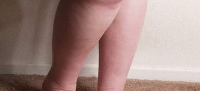 Лимфедема голени: причины, симптомы и методы лечения