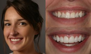 Что такое виниры на зубы и как они помогают создать красивую улыбку