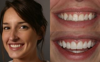Что такое виниры на зубы и как они помогают создать красивую улыбку