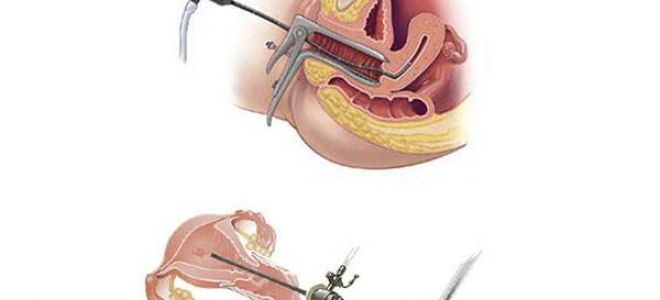 Беременность после удаления полипа эндометрия