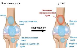 Как правильно лечить коленный сустав: советы и рекомендации