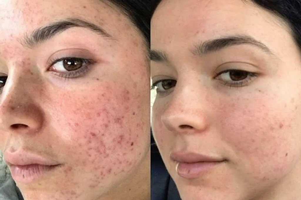 Причины появления акне